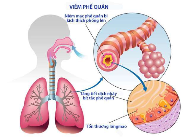 Viêm phế quản cấp