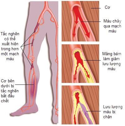 Kết quả hình ảnh cho bệnh động mạch ngoại biên