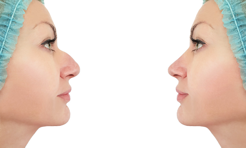Quy trình phẫu thuật nâng mũi bằng sụn sườn bạn nên biết!