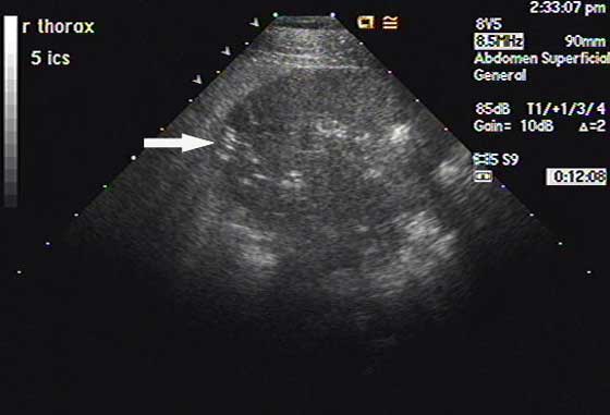 Sonogram of a bulging ventral area of severe consolidation obtained from the ventral most portion of the right lung in the 5th intercostal space.
