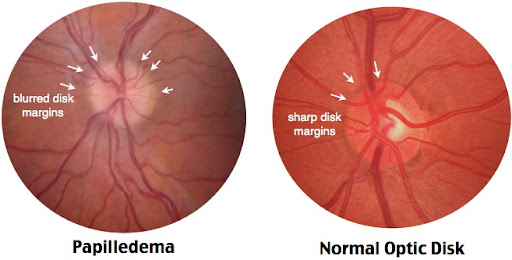 papiledema - um sinal mais comum em alterações de PIC crônicas pois, em lesões agudas, pode não haver alteração ao fundo de olho. Nesse caso, uma ferramenta importante seria a medição da bainha do nervo óptico com auxílio do Ultrassonografia Point-of-care (hipertensão intrecraniana)