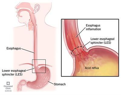 Acid refluxing back into the esophagus from the stomach