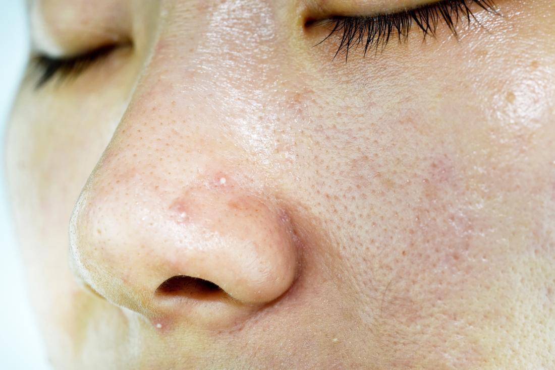 Cách nhận biết các loại da: da dầu, da khô, da nhạy cảm, da hỗn hợp và da  thường