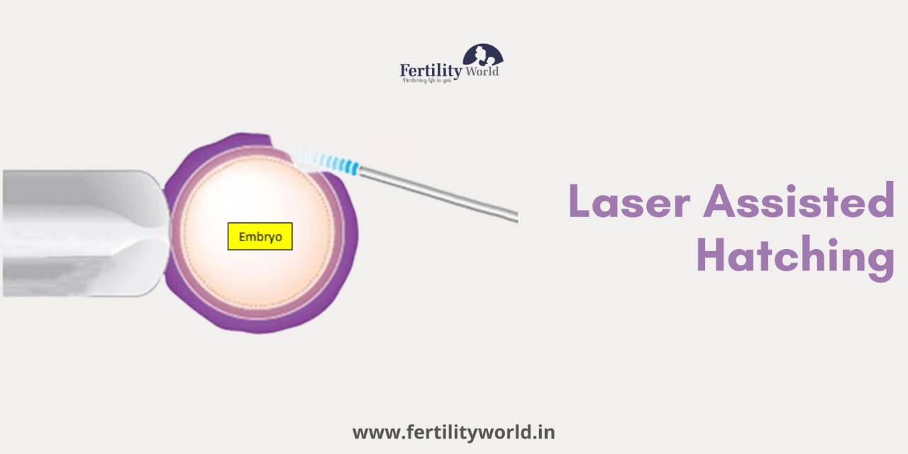 Cost of Laser-Assisted Hatching (LAH) in Jodhpur?