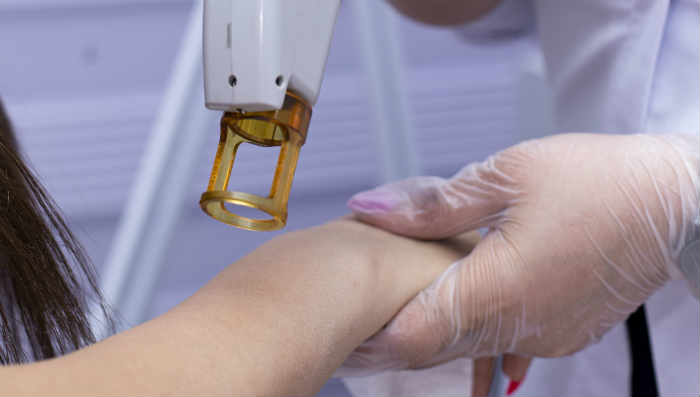Láser para borrar un tatuaje