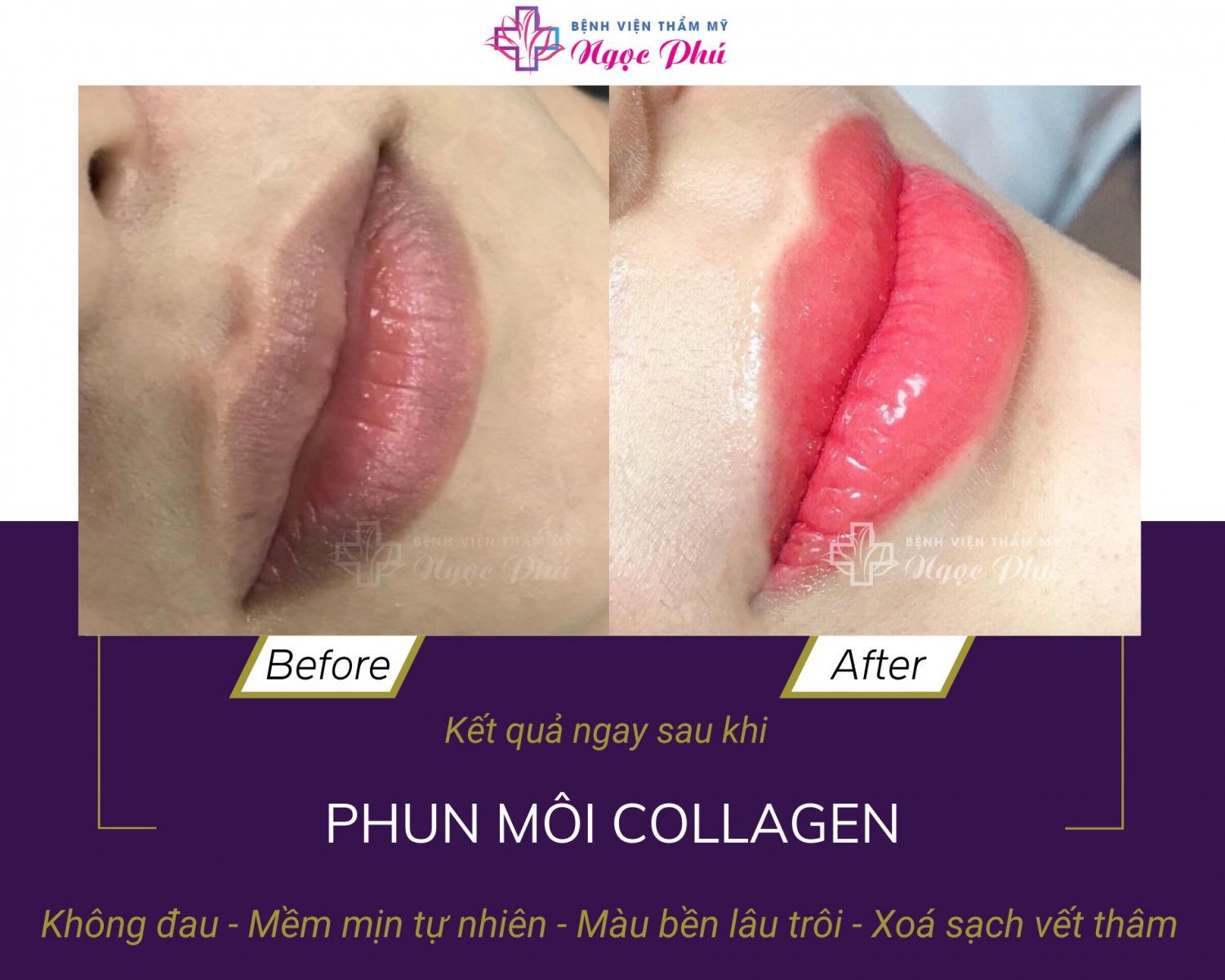 Tại Ngọc Phú có rất nhiều công nghệ phun môi hiện đại như: Phun môi collagen, phun môi phủ bóng, phun môi tế bào gốc,...