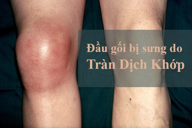 tràn dịch khớp gối có nên xoa bóp không