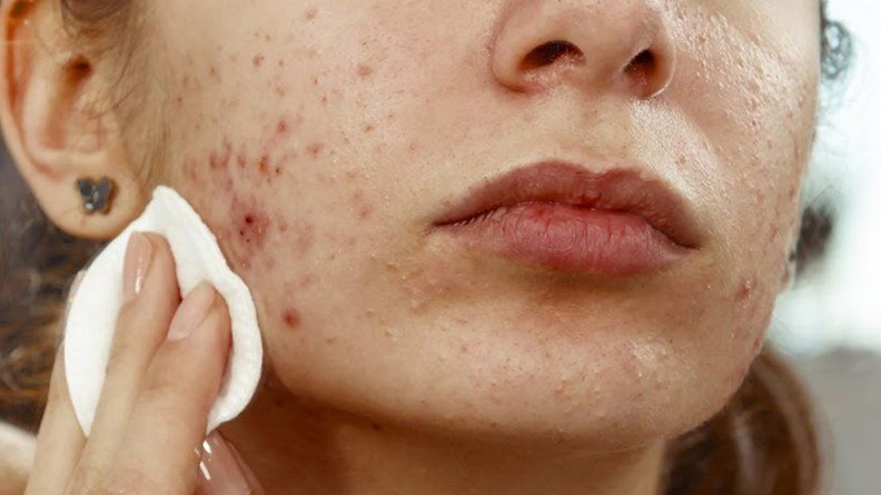 Khi da bị viêm nhiễm ở nang lông và tuyến bã sẽ hình thành nên mụn trứng cá