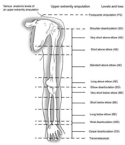 Types of upper-limb differences