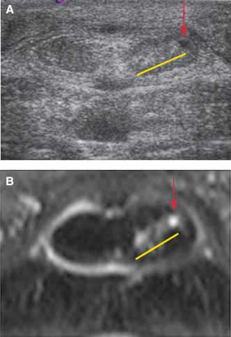  Comparison of a lesion in the medial lobe of the deep digital flexor tendon at level of the pastern on (A) an US image and (B) an MRI. The US image was made with the beam off angle or not perpendicular to the tendon fibers. The red arrow indicates an area of fiber disruption with focal fluid accumulation. This finding was equally evident on both modalities and was independent of beam angle on US images. The yellow line designates an area of tendon degeneration that did not have fiber disruption or focal fluid accumulation. This area was clearly evident on the MRI, but it was not readily seen on the US image until the probe was placed slightly off angle. Evidence of medial lobe enlargement was evident on both the US image and the MRI.