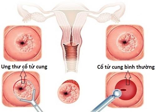 Cứ 2 phút lại có 1 phụ nữ tử vong vì ung thư cổ tử cung – Con số đáng báo  động- ghv.com.vn