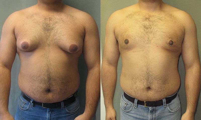 Paciente com ginecomastia antes e depois de correção cirúrgica.