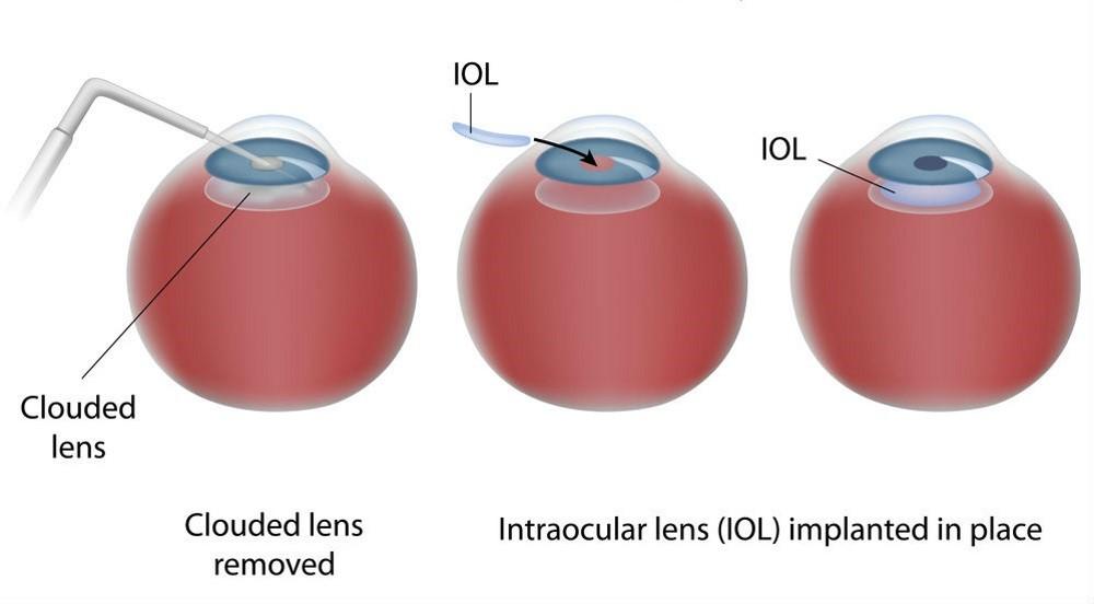 Cataract Lens Options Associated Retina Consultants