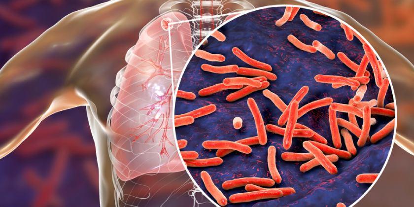 Representación de la bacteria de la tuberculosis en los pulmones.