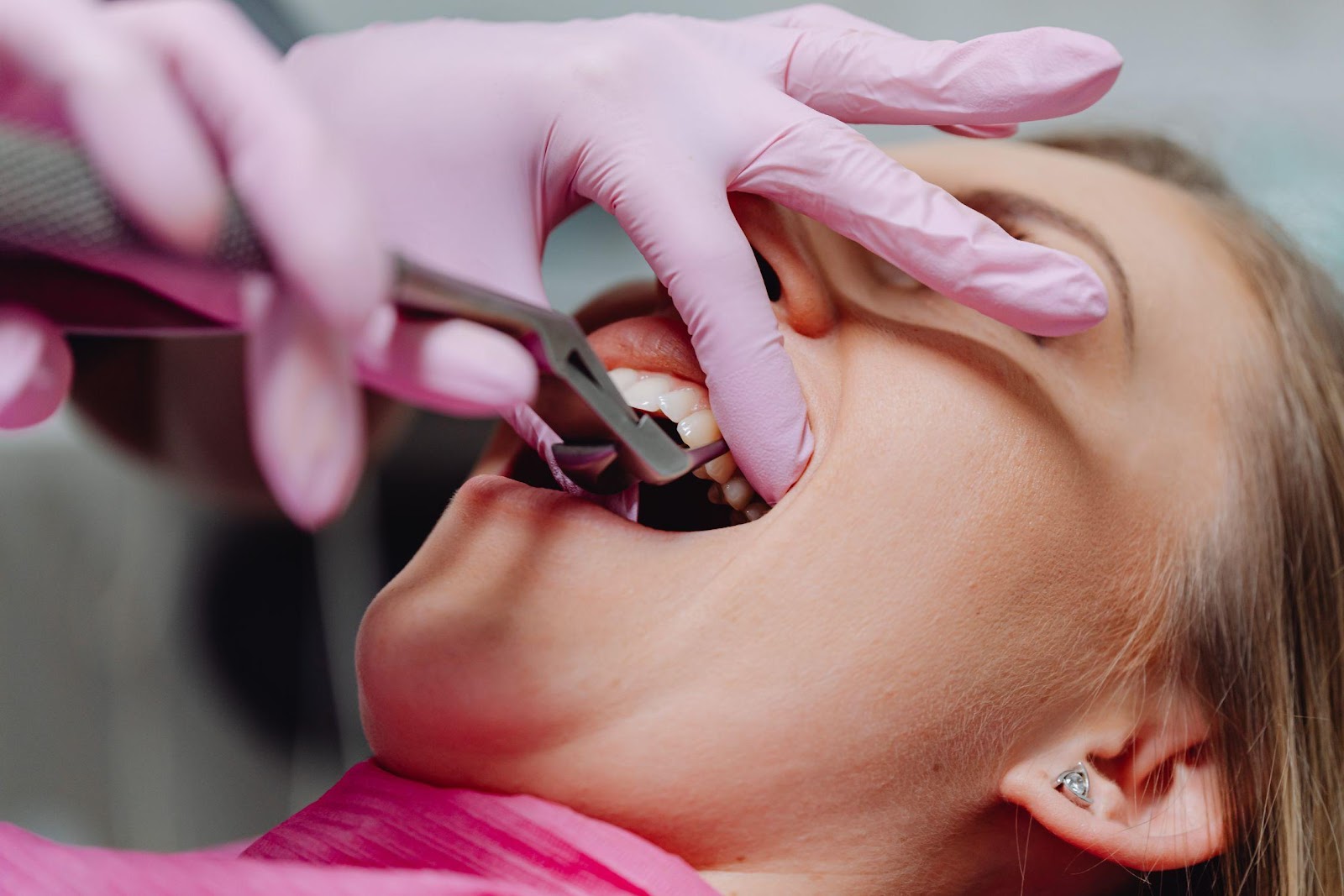 tooth extraction in Newmarket 