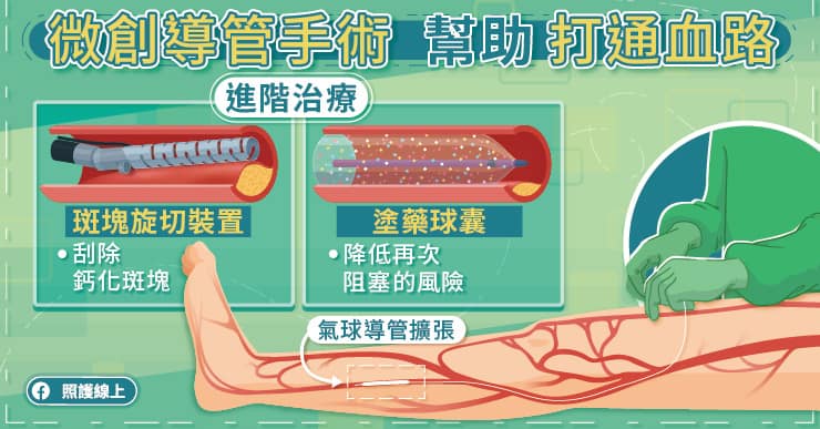 微創導管手術幫助打通血路