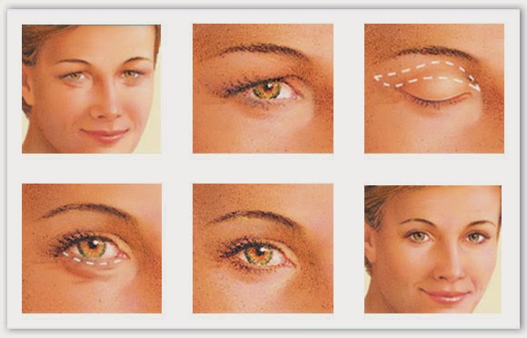 http://cosmetic-surgeon-online.com/treatments-blepharoplasty.html