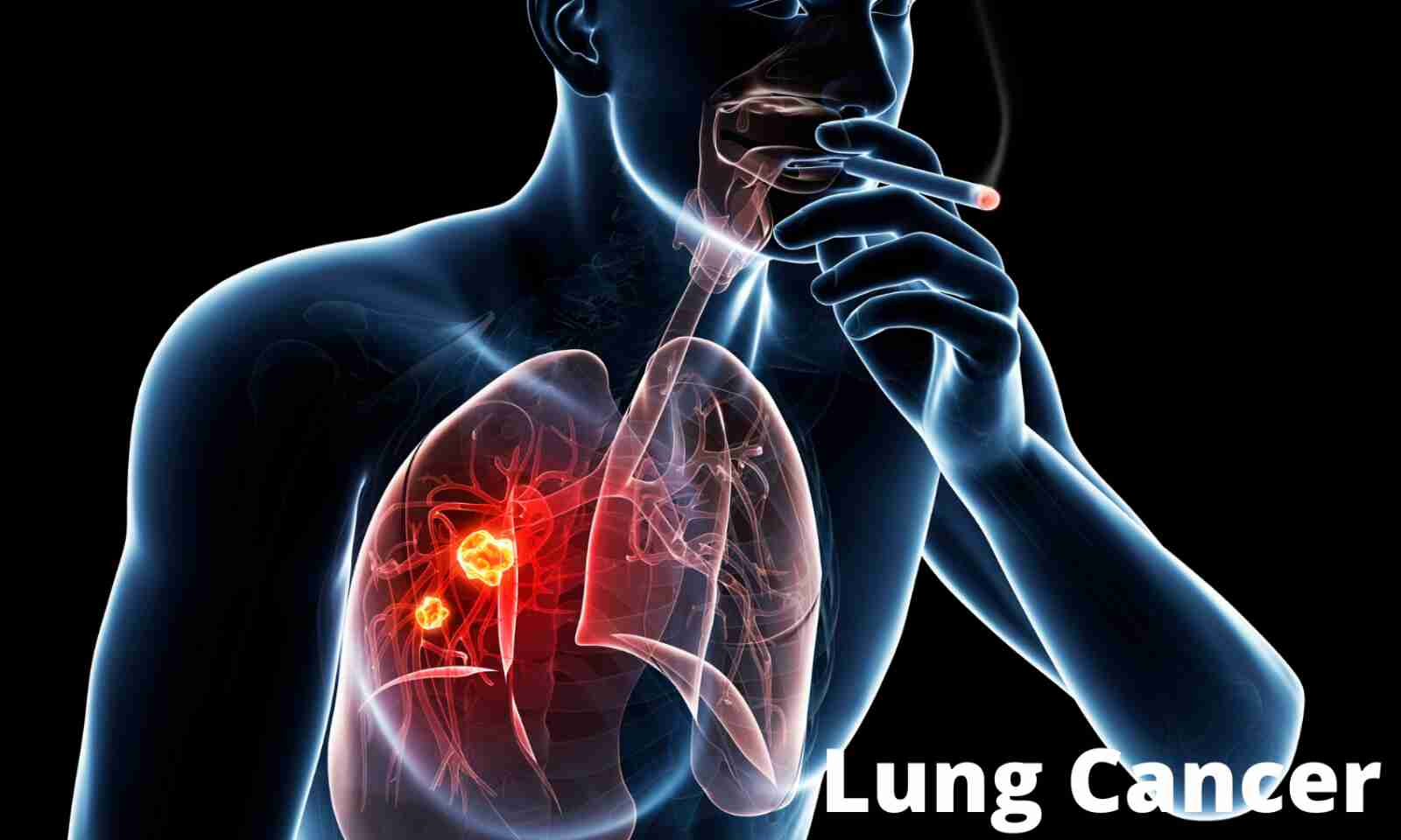 Lung cancer