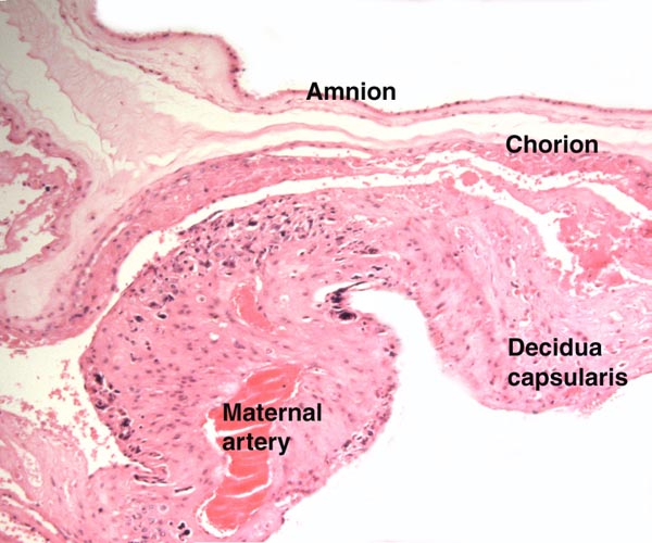 At left is a section from the margin of the placenta with the attachment of the membranes. Note the dark cells (extravillous trophoblast) that surround the maternal blood vessel