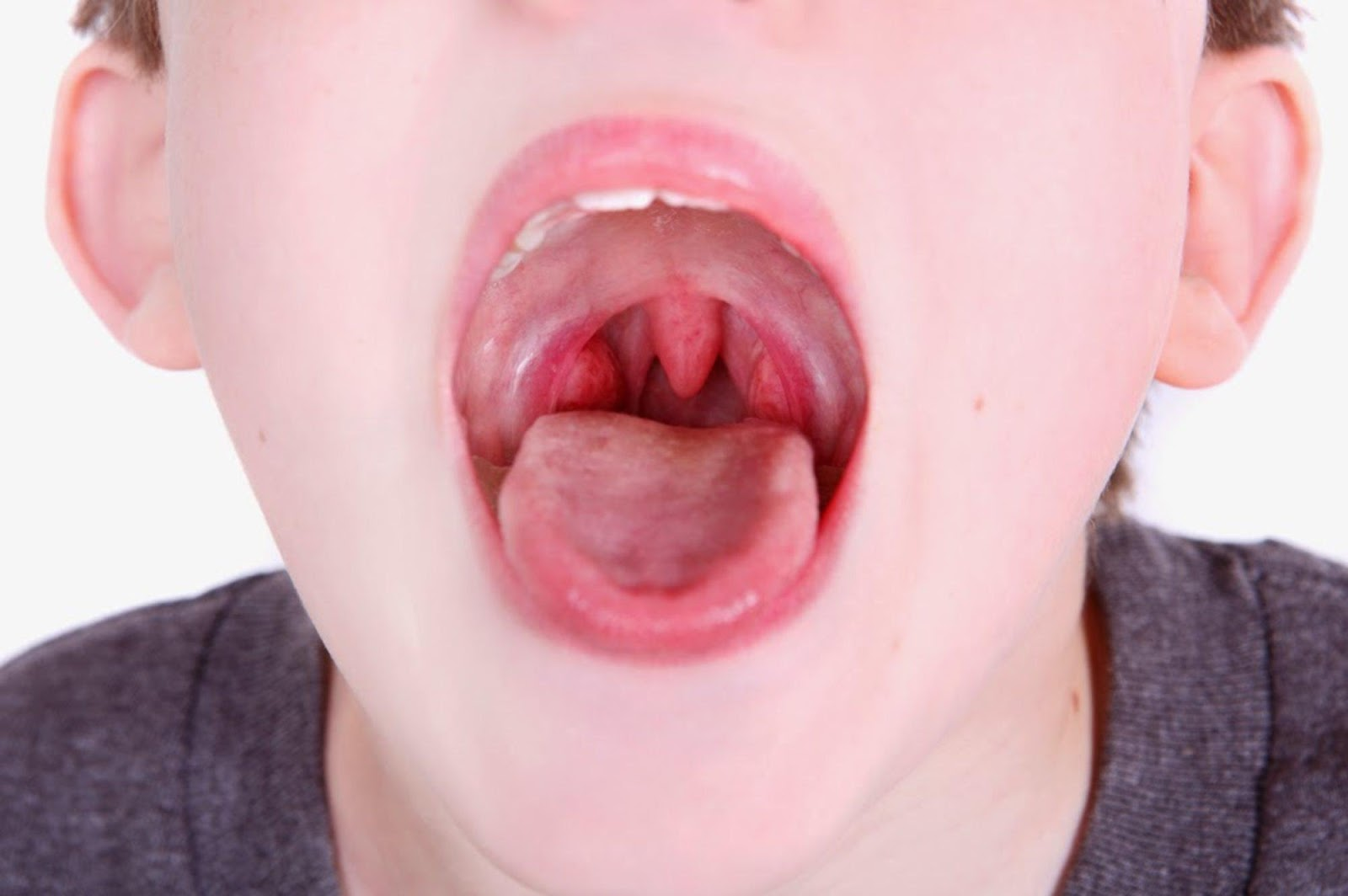 Viêm họng, viêm xoang cũng có thể khiến đau họng lâu khỏi