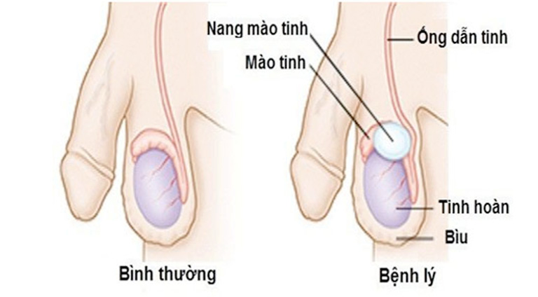 Viêm mào tinh hoàn
