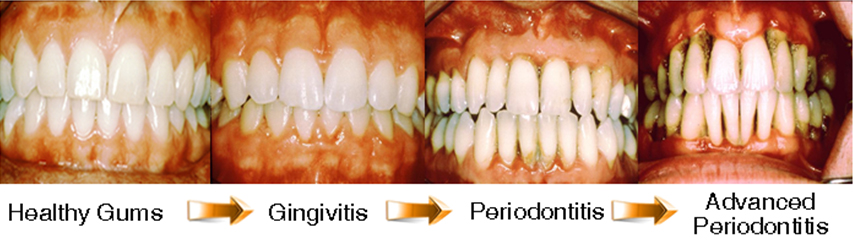 Smoking's Effect on your Oral Health 1