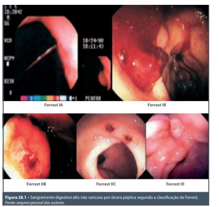 Sangramento digestivo alto não varicoso por úlcera péptica