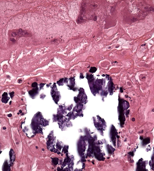 Higher magnification of the subplacenta (below) as it borders (above) the giant cell layer. The necrosis and calcifications are typical and normal.
