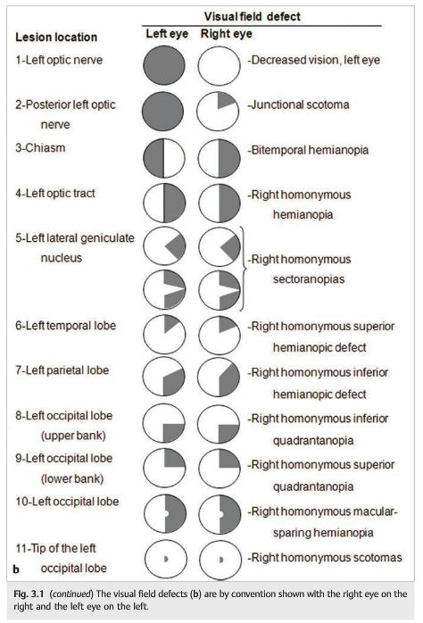 Neurological Visual Field Defect