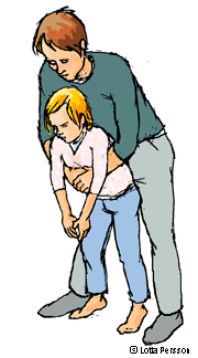 Illustration som visar hur man gör brösttryck om ett barn har satt i halsen