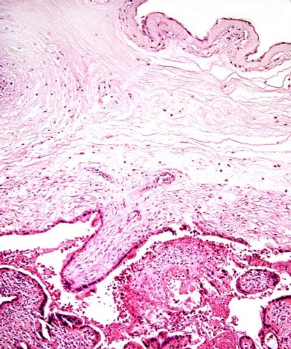 Surface of midterm placenta with amnion on top, loosely attached to the chorion