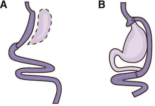 A: Cắt dạ dày theo chiều dọc.  B: Phẫu thuật cắt dạ dày Roux-en-Y.  Hình ảnh in lại từ Viện Quốc gia về Bệnh tiểu đường, Tiêu hóa và Bệnh thận (141).