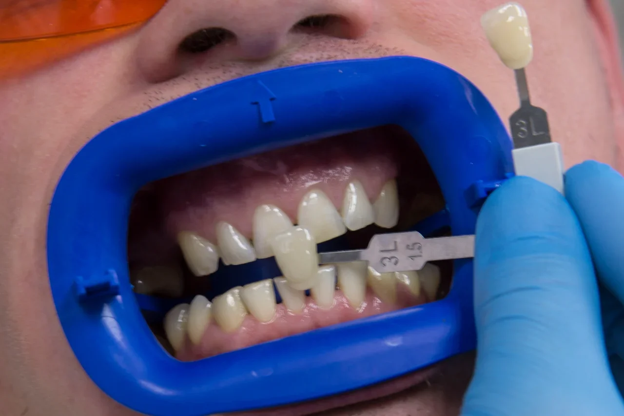 современное протезирование зубов