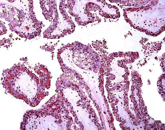 Low power villous tissue with 'inclusion'.