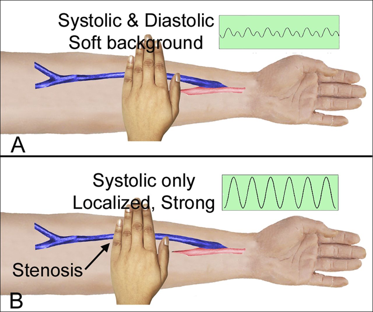 Normal Dialysis Fistula