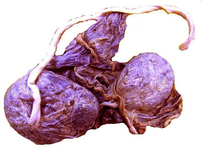 The bilobed placenta of Delacour’s langur. The lobes are connected by large chorial vessels in the membranes.