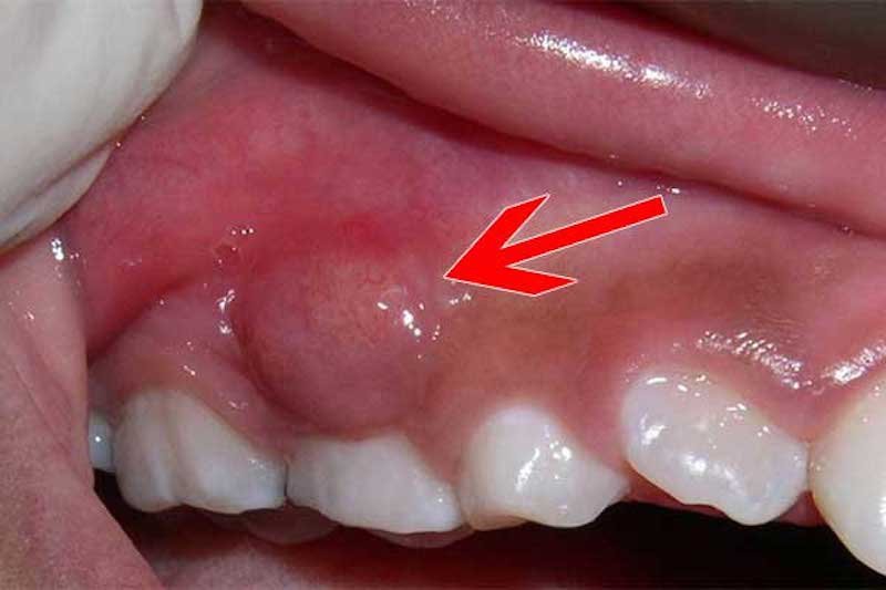 Phần nướu dưới dưới chân răng bị sưng tấy do vi khuẩn tấn công