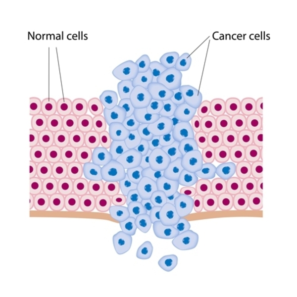 abnormal growth of the cancer cells