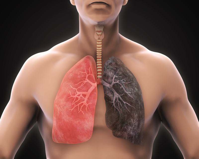 ung thư phổi sống được bao lâu,ung thư màng phổi sống được bao lâu,xạ trị ung thư phổi sống được bao lâu,ung thư phổi ác tính sống được bao lâu,ung thư phổi tái phát sống được bao lâu