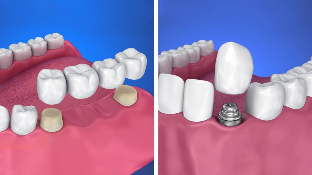 протезирование зубов что такое