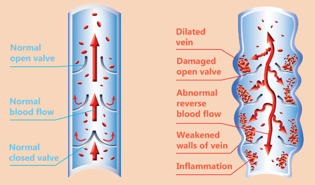  Dangers of Varicose Veins