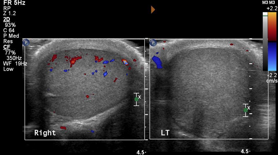 Testicular Torsion