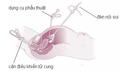 Phương pháp mổ nội soi u xơ tử cung