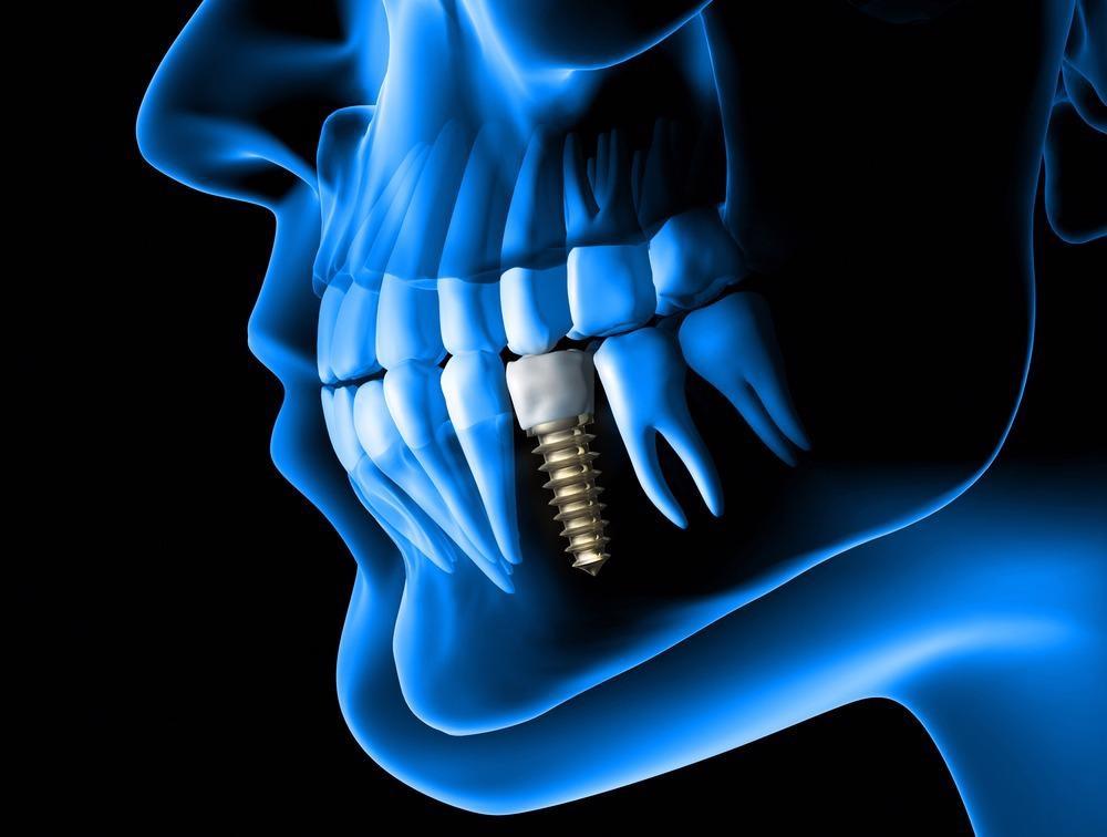Nanobiotechnology Used to Improve Safety of Titanium Dental Implants