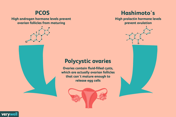 Pregnancy With PCOS And Thyroid