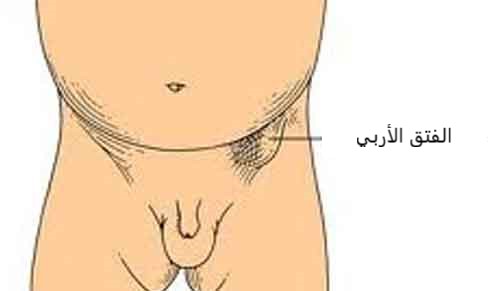 الفتق الأربي عند الأطفال