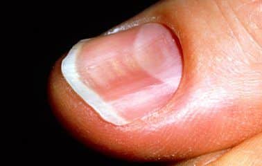Damage to nails due to iron deficiency