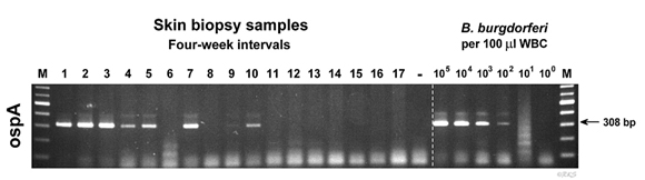 Detection of B. burgdorferi-specific DNA (ospA gene) by conventional qualitative PCR and agarose gel electrophoresis. DNA is stained with ethidium bromide and visualized over a ultraviolet light source. Skin biopsy samples were takes near the site of tick exposure in four-week intervals.