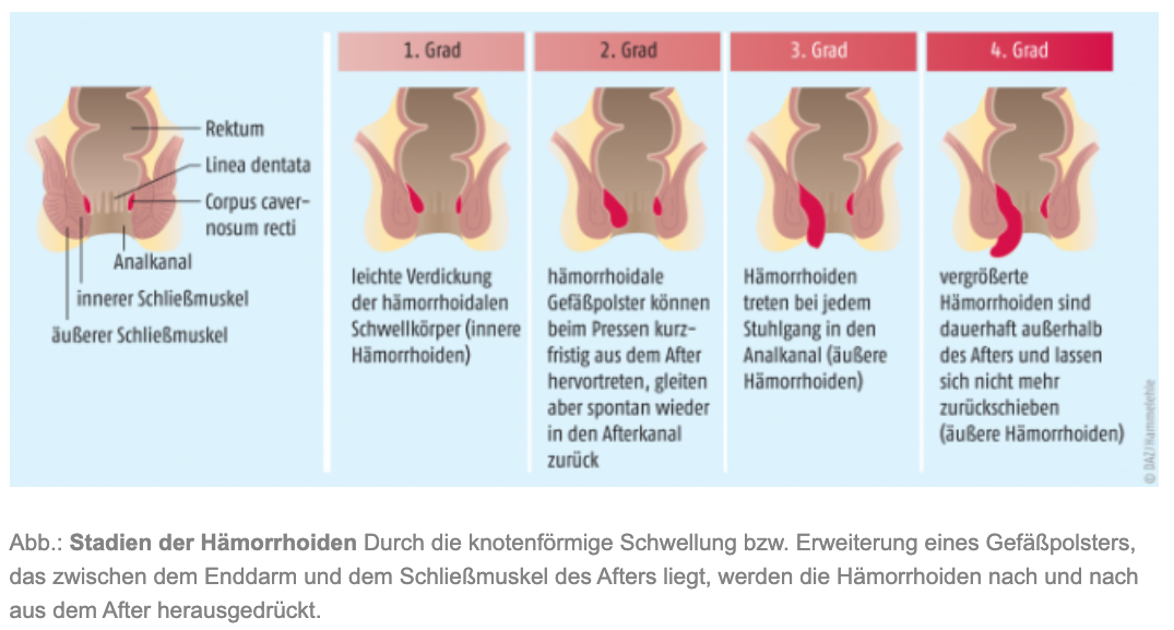 70 Hämorrhoiden Gesünder Mit Praktischer Medizin