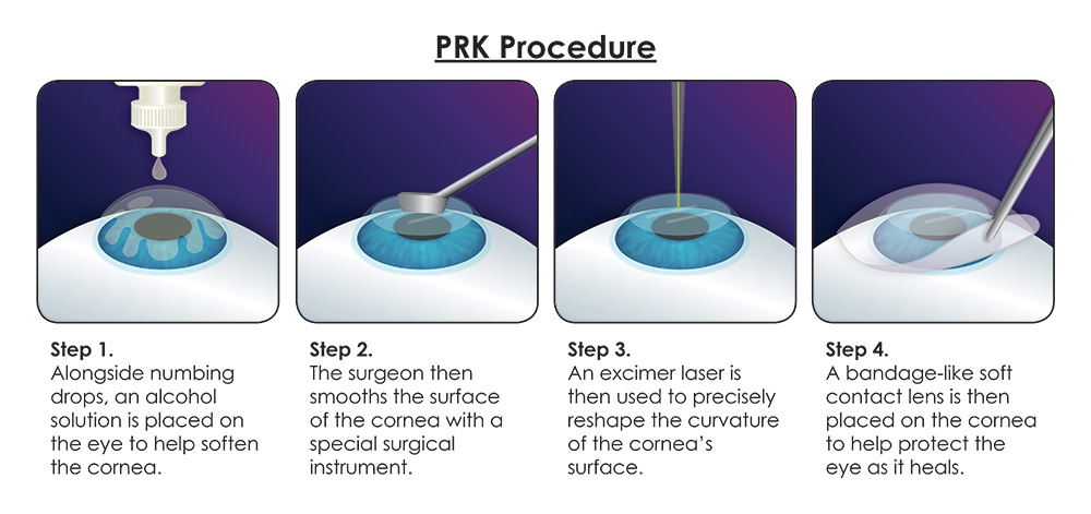 prk-procedure.jpg